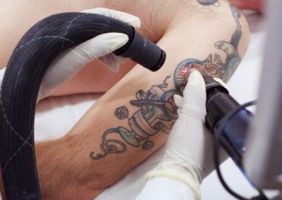 laser-tattoo-removal-Phuket-1024x563