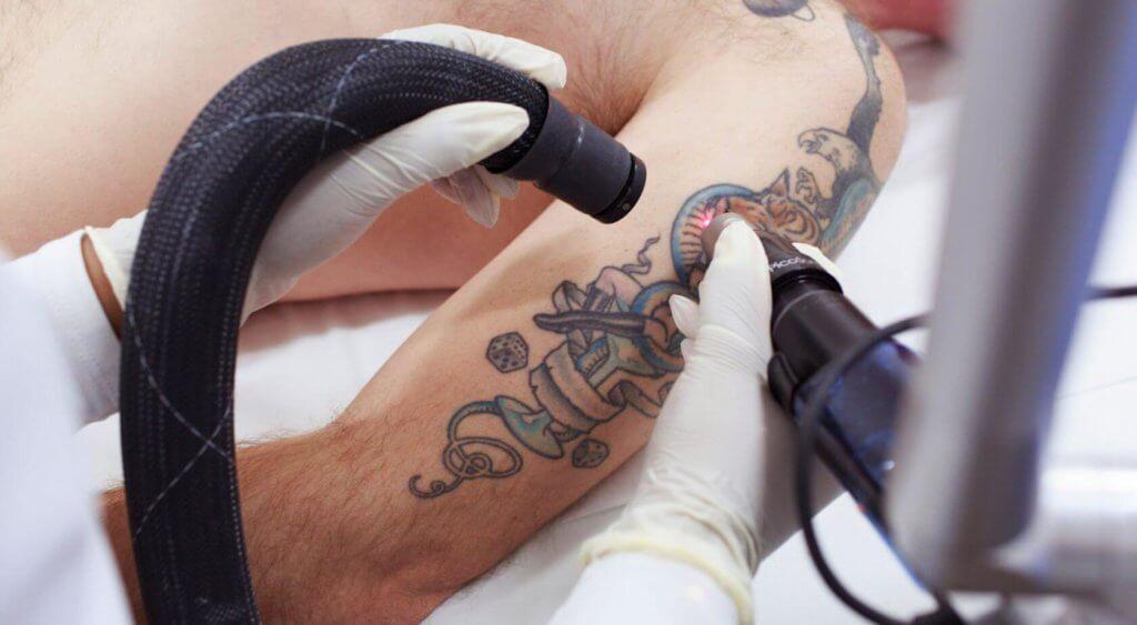 How much does tattoo removal cost?