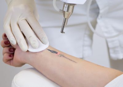 laser-tattoo-removal-laser-tattoo-removal-8